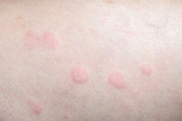 Skin allergy rash dermatitis texture close up