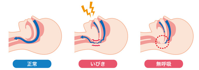 石破さんは睡眠時無呼吸症候群なんですか？