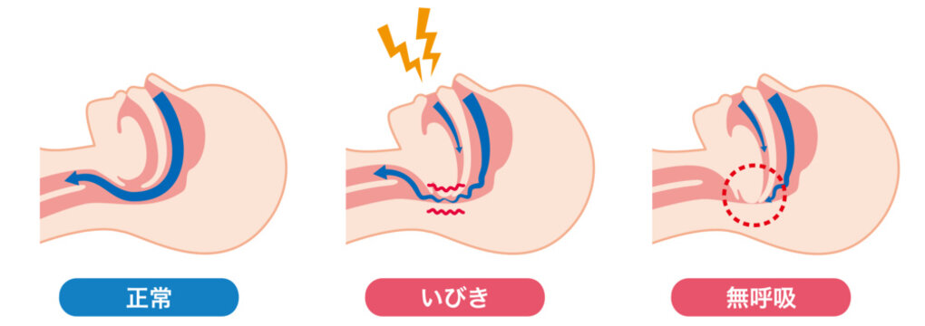いびきと睡眠時無呼吸症候群