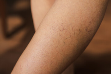 Varicose veins. Vascular diseases. Varicose veins of small vessels on the skin of a woman's thigh. Varicose veins on the woman legs, Vascular, Thrombosis.