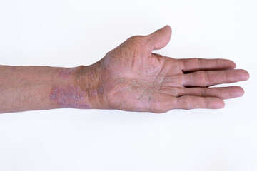Acute psoriasis on the skin ,body , is an autoimmune incurable dermatological skin disease. Isolated on white background.