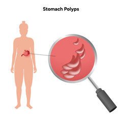 Stomach polyps