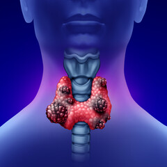 Cancer of the Thyroid gland concept as a human organ with a malignant tumor growth as a symbol for endocrinology system disease.