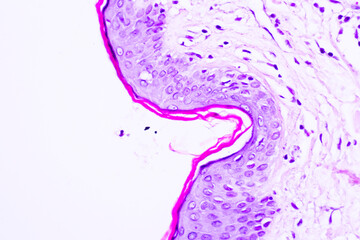 Backgrounds of human cells tissue of cervix under the microscope in pathology lab.View in microscopic of ductal cell carcinoma, adenonocarcinoma from human breast cancer, tissue section by H and E