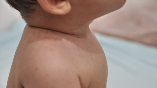 Baby girl with red rash on her skin, measles or chicken pox on newborn