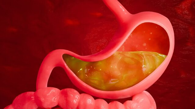 Gastric reflux and stomach burning caused by excessive stomach acid, depicting symptoms like digestion upset and intestinal inflammation in medical concept 3D Rendering.