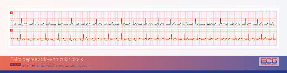 Third degree atrioventricular block in young women may be congenital, with the block located on the atrioventricular node or above bifurcation of the His bundle.
