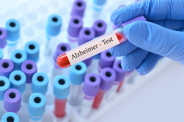 Doctor holding a test blood sample tube with Alzheimer test on the background of medical test tubes...