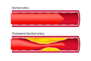 Normal artery and cholesterol blocked artery. Clogged arteries caused by cholesterol. Normal blood flow and Cholesterol in blood vessels.