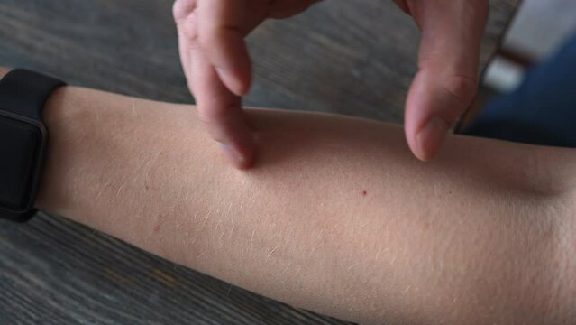 Top view of male arm having allergic reaction after playing with cat. Young man skin breaking out in hives resulting in small blisters, severe itching and discomfort. Shooting in slow motion.