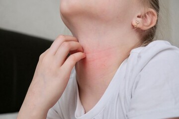 The child scratches atopic skin. Dermatitis, diathesis, allergy on the child's face.	