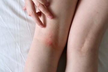 The child scratches atopic skin. Dermatitis, diathesis, allergy on the child's leg
