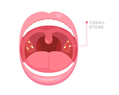 Illustration of mouth anatomy with tonsil stones in tonsil gland. Concept of bad breath, oral health, bacterial and viral infection at tonsil gland, sore throat, halitosis. Flat vector illustration.