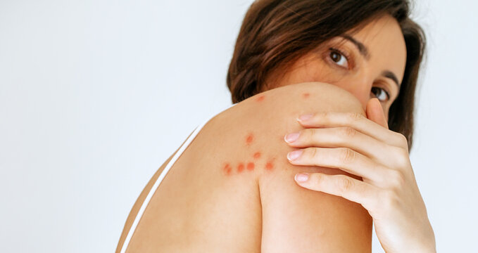 A woman scratches her shoulder bitten by a bedbug on a white background, close-up. Skin health problem. Red pimples. Banner