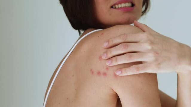 A woman scratches her shoulder bitten by a bedbug on a white background, close-up. Skin health problem. Red pimples.
