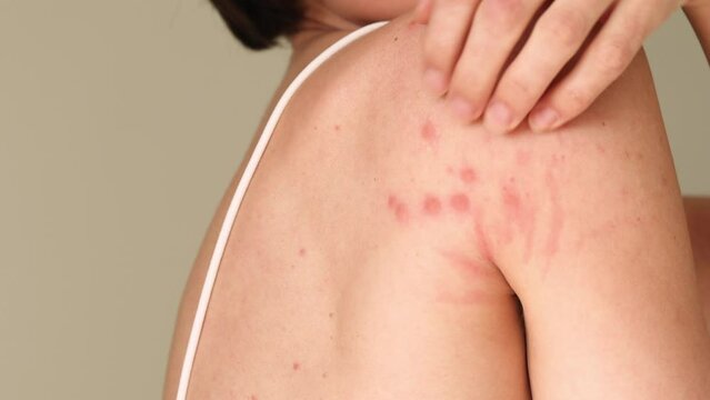 A woman scratches her shoulder bitten by a bedbug on a white background, close-up. Skin health problem. Red pimples.