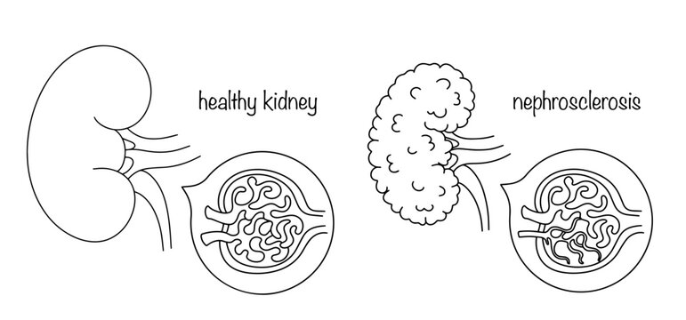 Nephrosclerosis