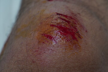 Wound on knee.