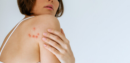 A woman scratches her shoulder bitten by a bedbug on a white background, close-up. Skin health...