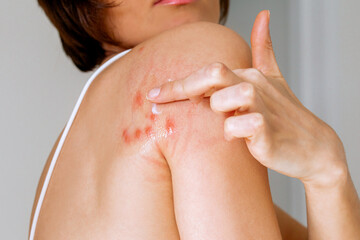 A woman applies ointment to her shoulder that was bitten by a bedbug on a white background,...