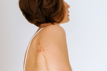 A woman with her shoulder bitten by a bedbug on a white background, close-up. Skin health problem....