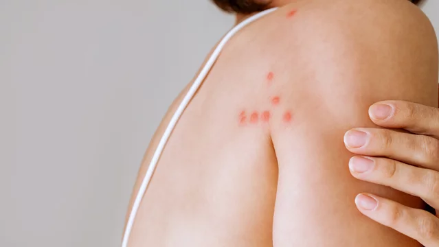 A woman with her shoulder bitten by a bedbug on a white background, close-up. Skin health problem. Red pimples
