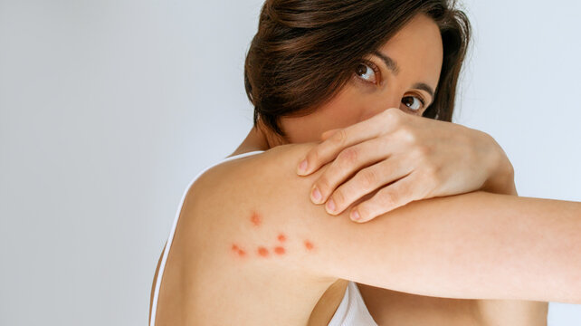 A woman scratches her shoulder bitten by a bedbug on a white background, close-up. Skin health problem. Red pimples.