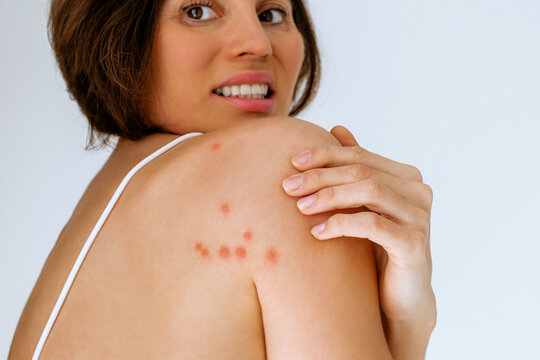 A woman scratches her shoulder bitten by a bedbug on a white background, close-up. Skin health problem. Red pimples.