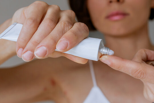 A woman presses the ointment onto her finger and applies it to the bite site by a bedbug on her shoulder on a white background, close-up. Skin health problem. Red pimples.