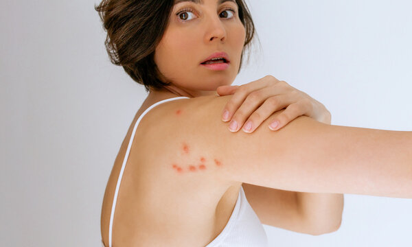 A woman scratches her shoulder bitten by a bedbug on a white background, close-up. Skin health problem. Red pimples.