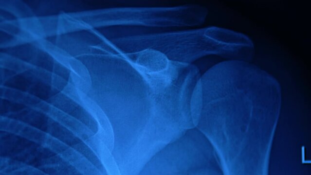 X-ray shot of a shoulder joint. Close up. Scanning before the surgery for trauma healing.