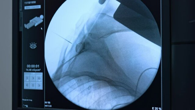 X-ray scans of a patient under surgery. Shoulder joint shots on the monitors of medical equipment.