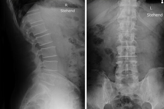 x-ray images spine of lumbar vertebrae spinal of herniated disc Disease  patient.