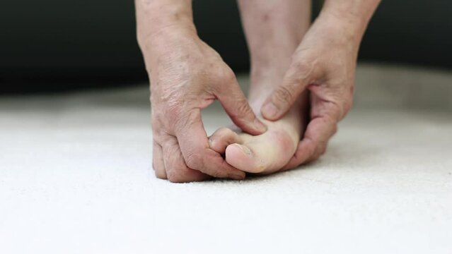 Hand touching a foot suffering from hallux valgus