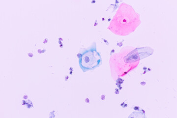 Abnormal squamous epithelial cells view in microscopy.HPV criteria for pap smear slide cytology and pathology.Koilocyte cells on white background.Human cell medical concept.