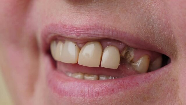 Unrecognizable woman with bad broken teeth. Female mouth with damaged and cracked tooth. Closeup