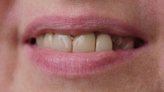 Unrecognizable woman with bad broken teeth. Female mouth with damaged and cracked tooth. Closeup