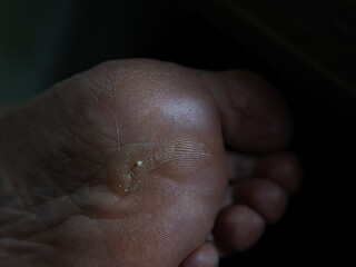 callus on a woman's foot