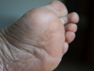 callus on a woman's foot