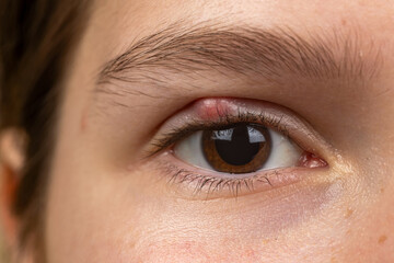 Chalazion on the eyelid of girl macro. Demodicosis mite diseas, demodex. Eye of girl with stye...