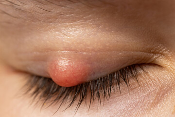 Chalazion on the eyelid of a girl close-up