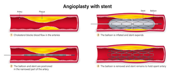 Steps of angioplasty with stent. Balloon is inflated, stent expands so that it holds open the narrowed blood vessel. Balloon is let down and removed, leaving the stent in place.