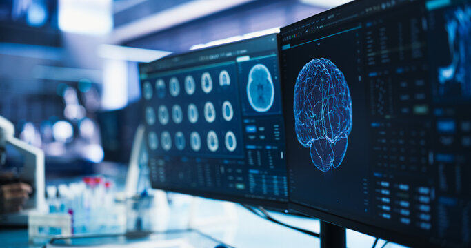 Cancer Research Center Medical Laboratory: Close Up of a Set of Desktop Computer Monitors Showing CT Scans Of Human Brain. Specialist Studying Brain Tumor, Finding Solutions, Treatment