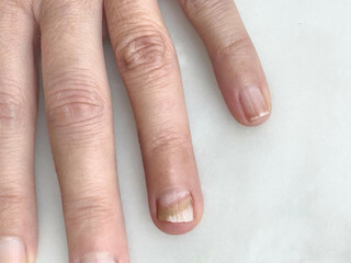female hand with brittle fingernail. Fungal infection