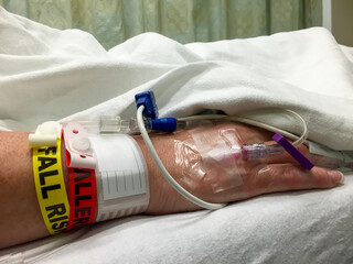 Intravenous line in the back of a woman’s hand with warning wrist bands