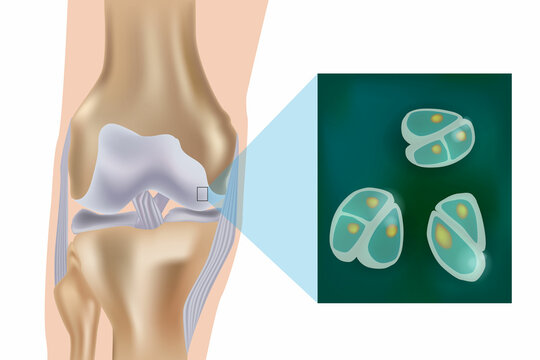 Schematic depiction of articular cartilage and chondrocytes of the joint surface. Structural and molecular changes during OA process. Chondrocytes