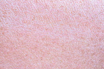 dry and dehydrated human skin texture background