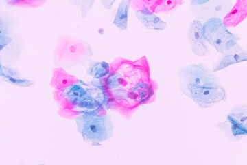 Abnormal squamous epithelial cells view in microscopy.HPV criteria for pap smear slide cytology and...