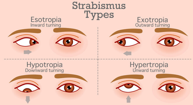 Strabismus types, crossed eyes, disease. Inward turning, outward, upward, downward. Esotropia, hypotropia, exotropia, hypertropia,. Skin color background. Vector illustration	