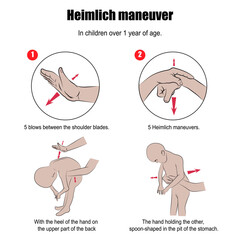 Heimlich maneuver, first aid procedure used when a person is drowning.